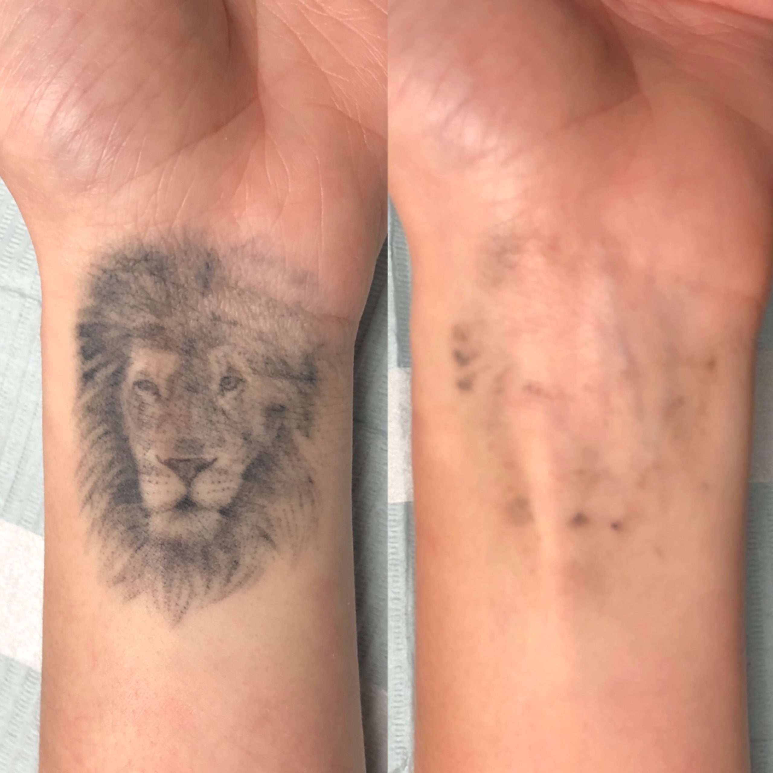 Laser Tattoo Removal Vancouver / Toronto