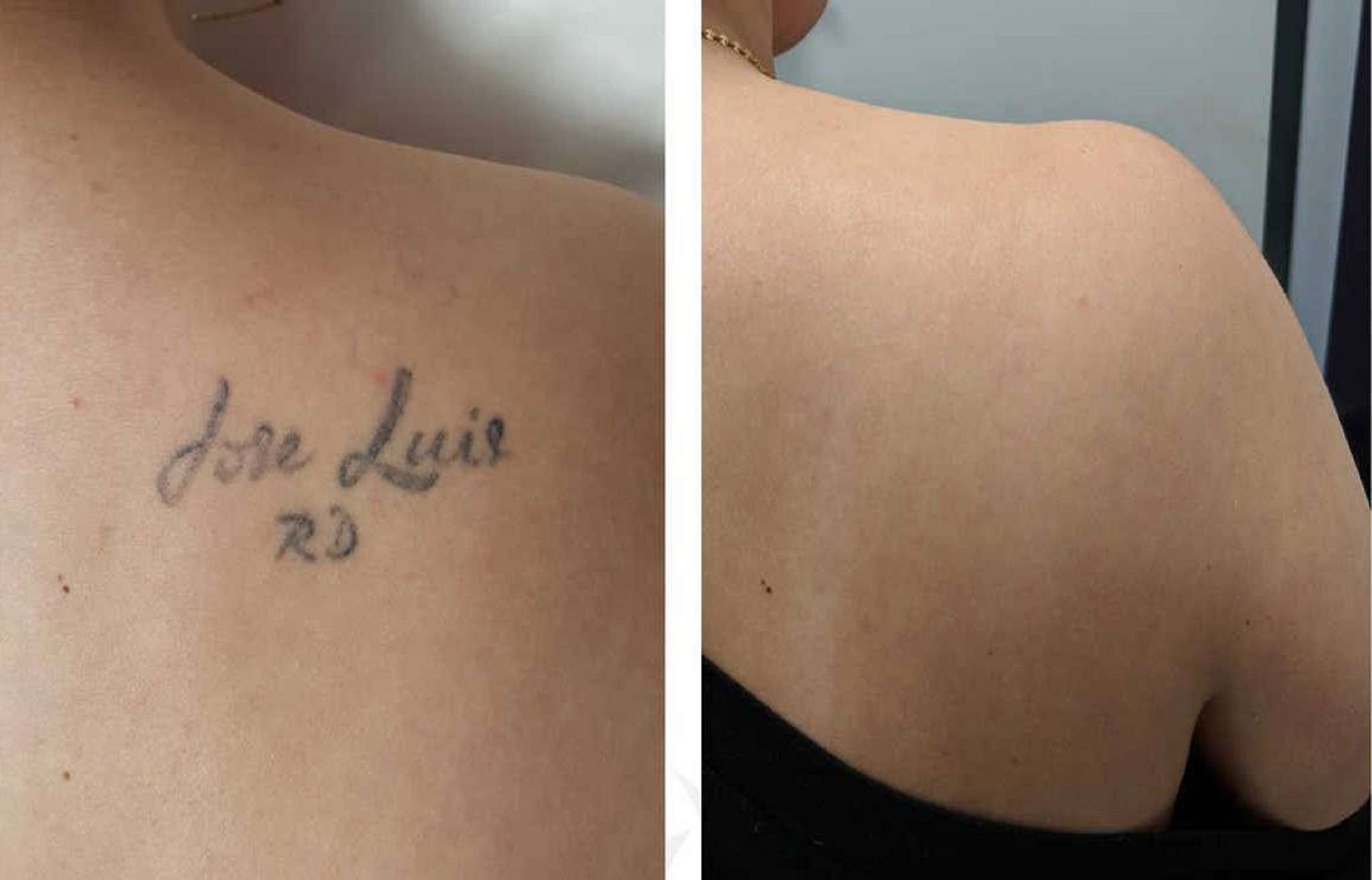 Laser Tattoo Removal: What You Need to Know ...