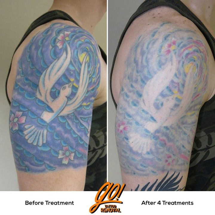 Laser Tattoo Removal Yellow Ink