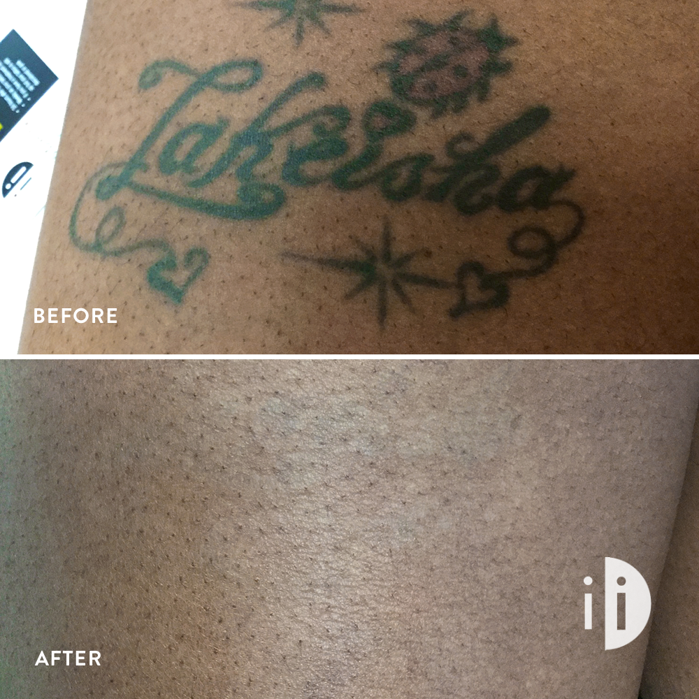 Laser Tattoo Removals on Dark Skin: Before and After!