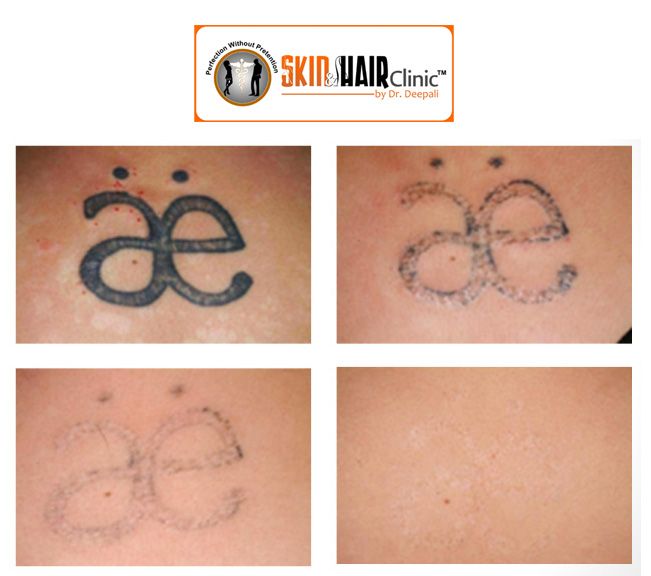 Laser #Tattoo_Removal @dr deep