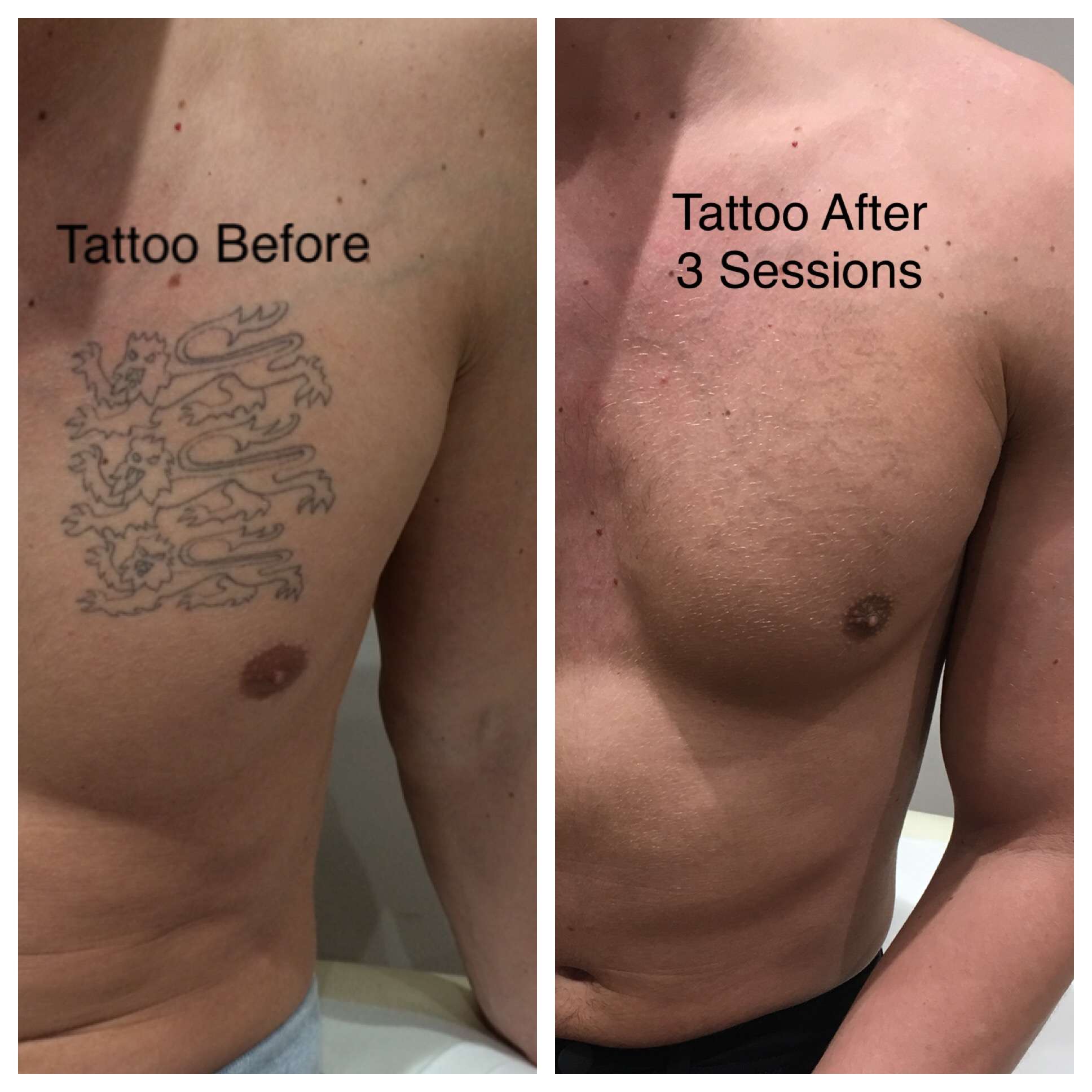 How Much Does It Cost To Remove Small Tattoo TattooTalk