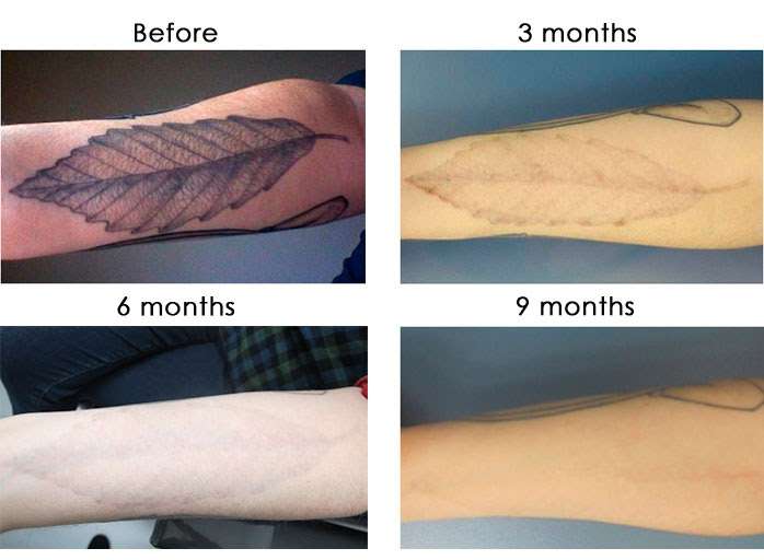 Laser Treatment For Tattoo Removal Price In India