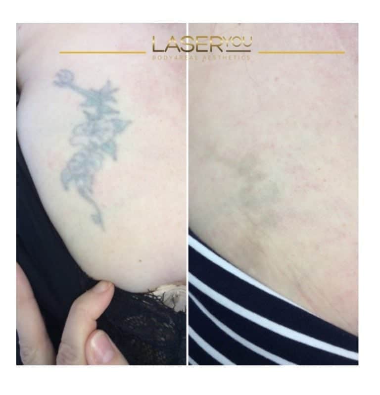 Latest 2021 before and after photos for Laser Tattoo Removal @ LaserYou ...