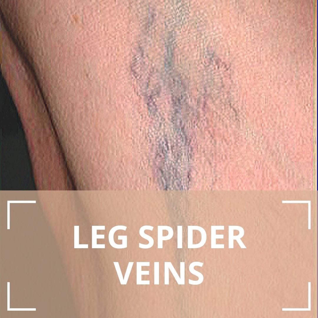 Leg Spider Veins