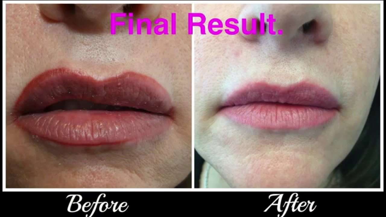 Lip tattoo Correction/Removal
