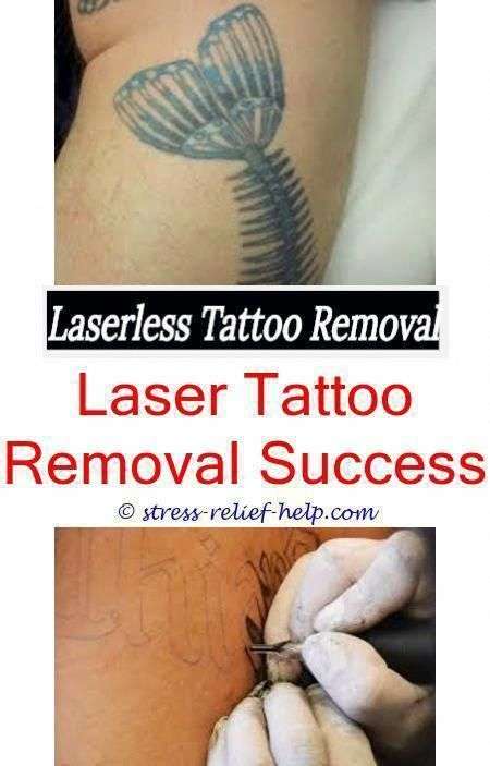 local tattoo removal abilene tattoo removal