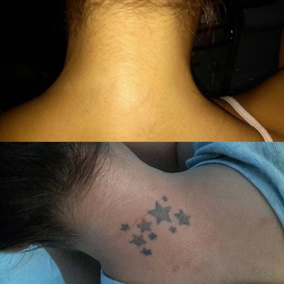 Looking For " Tattoo Removal Near Me"  In Orlando? Call Us!