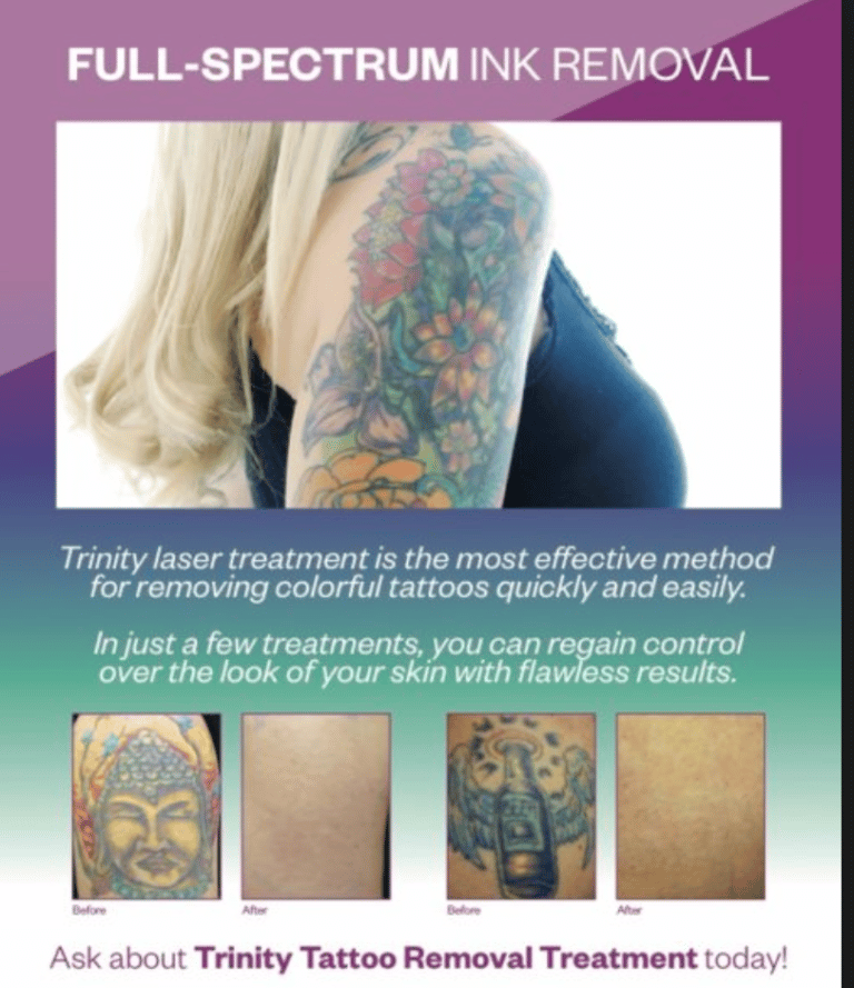 Madison Laser Tattoo Removal