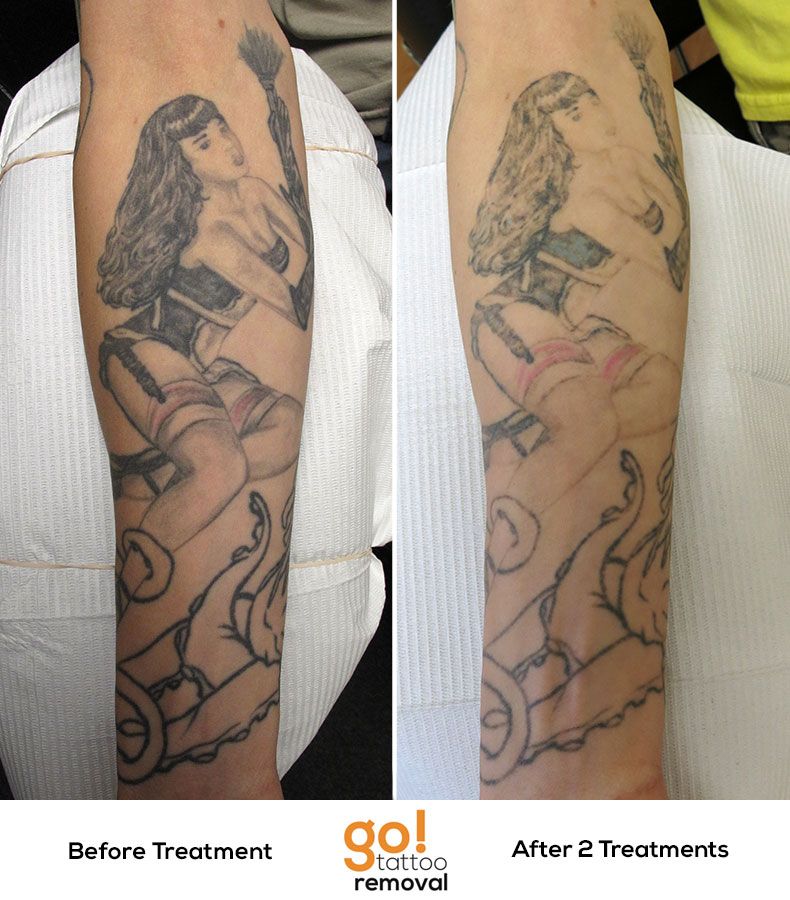 Making progress after 2 laser tattoo removal treatments on this forearm ...