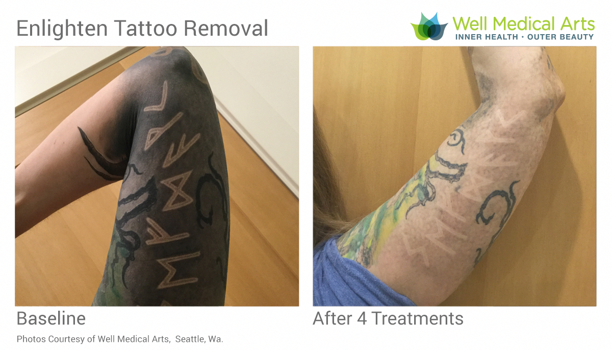 More amazing laser tattoo removal before and after photos ...