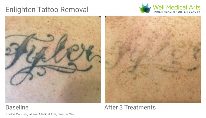 More Awesome results with our Cutera Enlighten Tattoo ...
