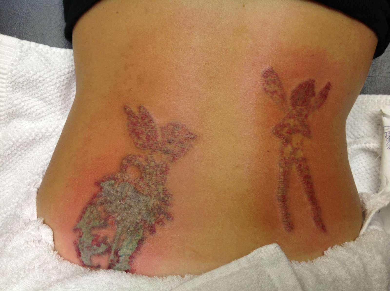 My tattoo removal process: Day 1: My tattoos before and ...