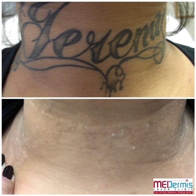 Neck &  Face Laser Tattoo Removal Before &  After Results