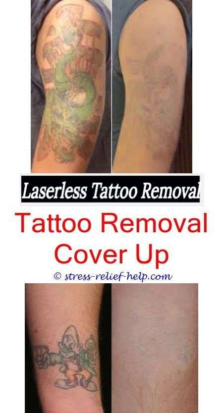 new laser tattoo removal laser tattoo removal large tattoo