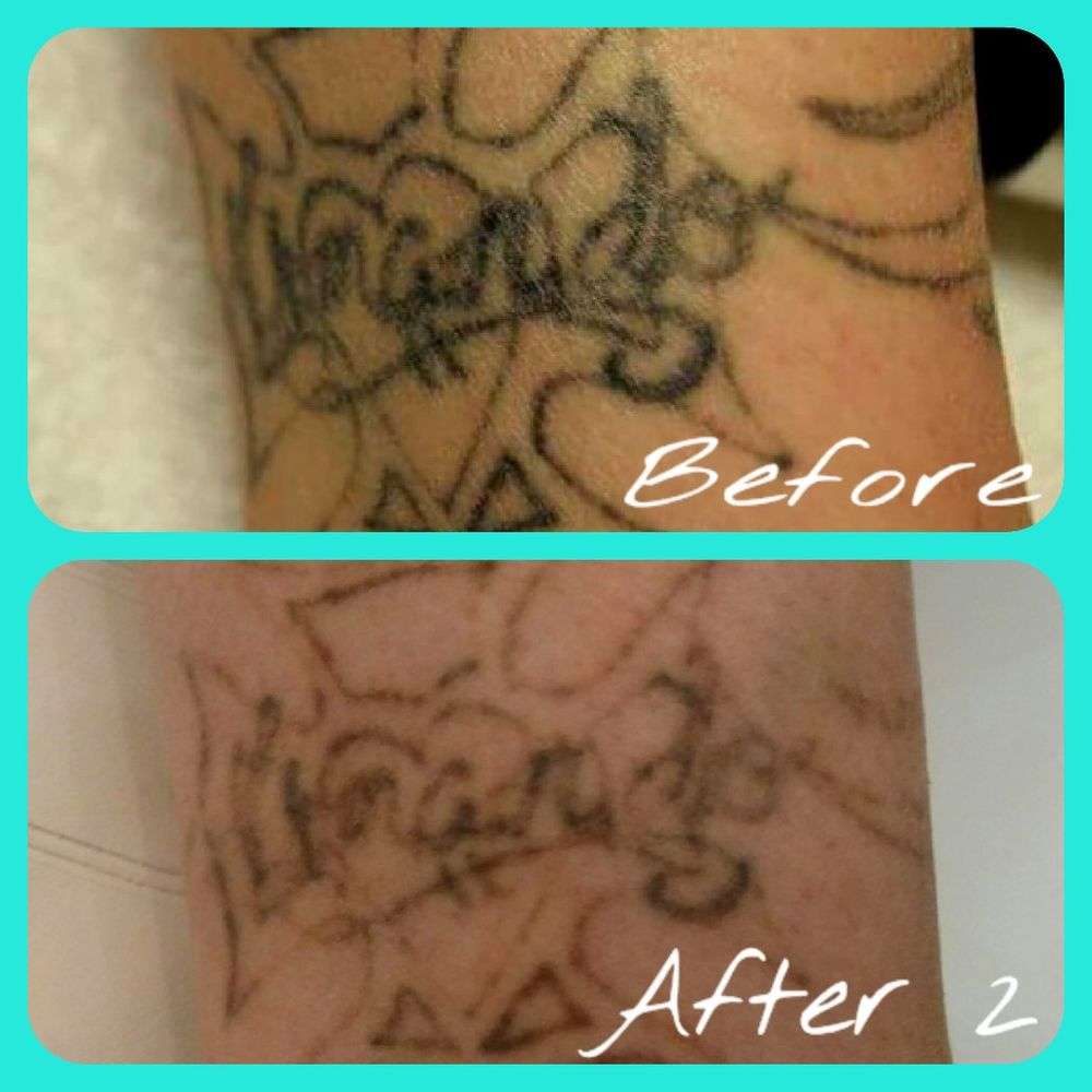 Oops! Laser Tattoo Removal
