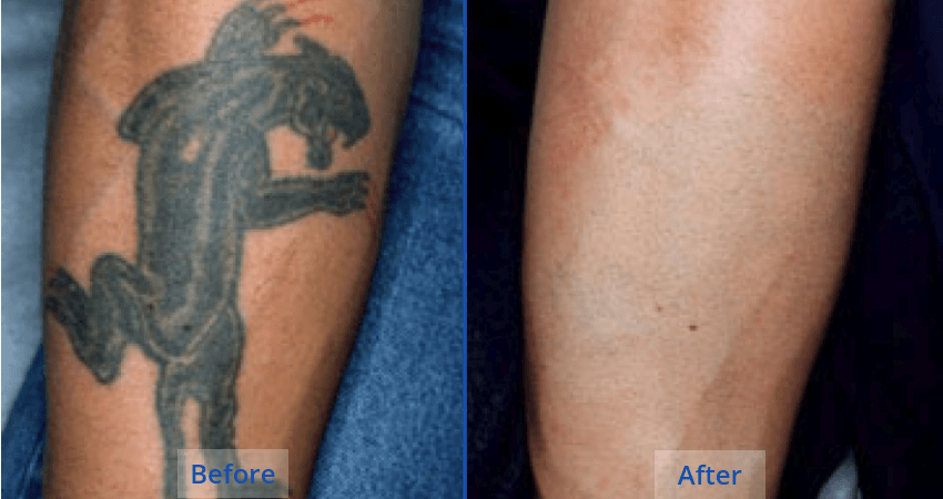 Optimized Laser Tattoo Removal Procedure