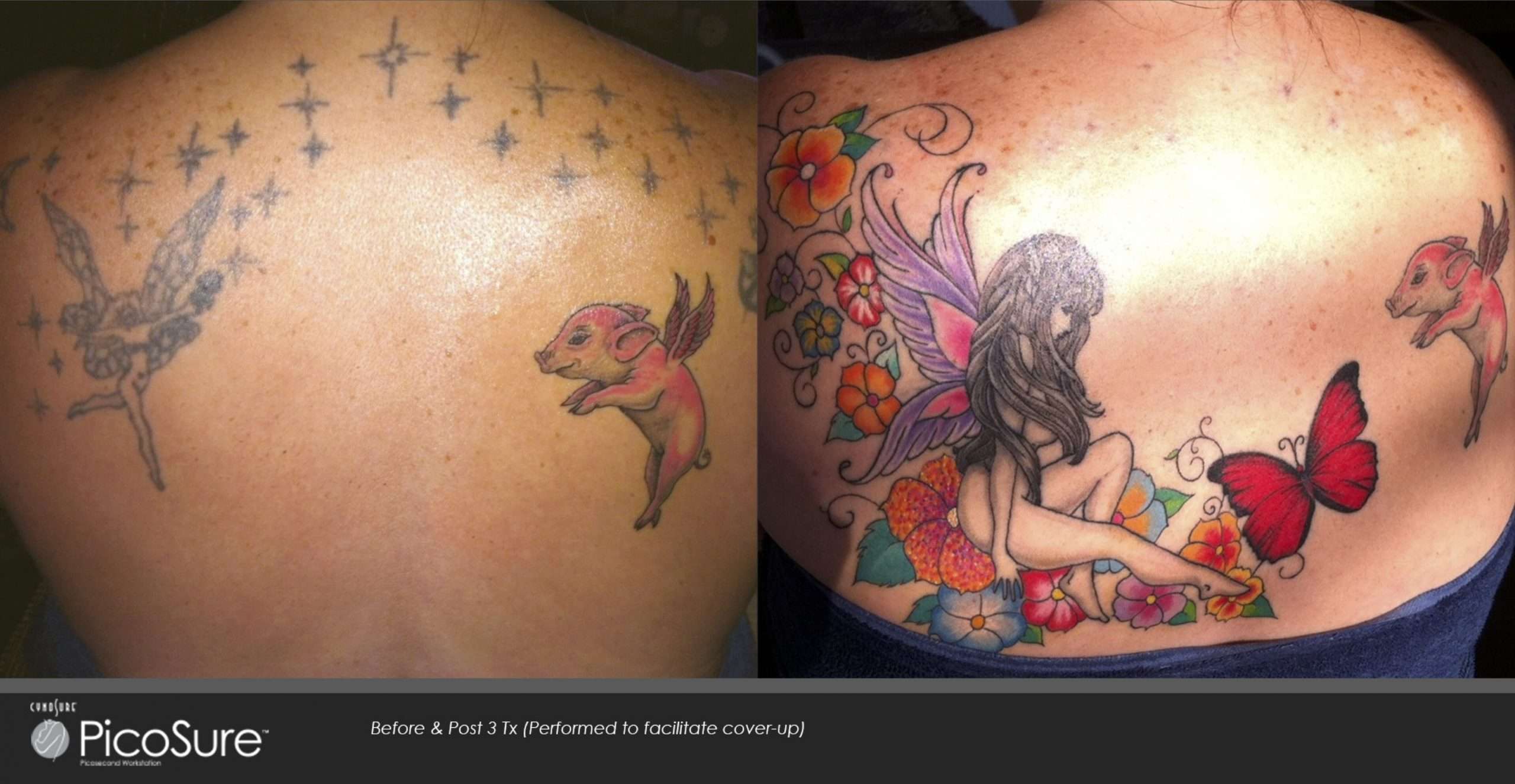Orland Park laser tattoo removal