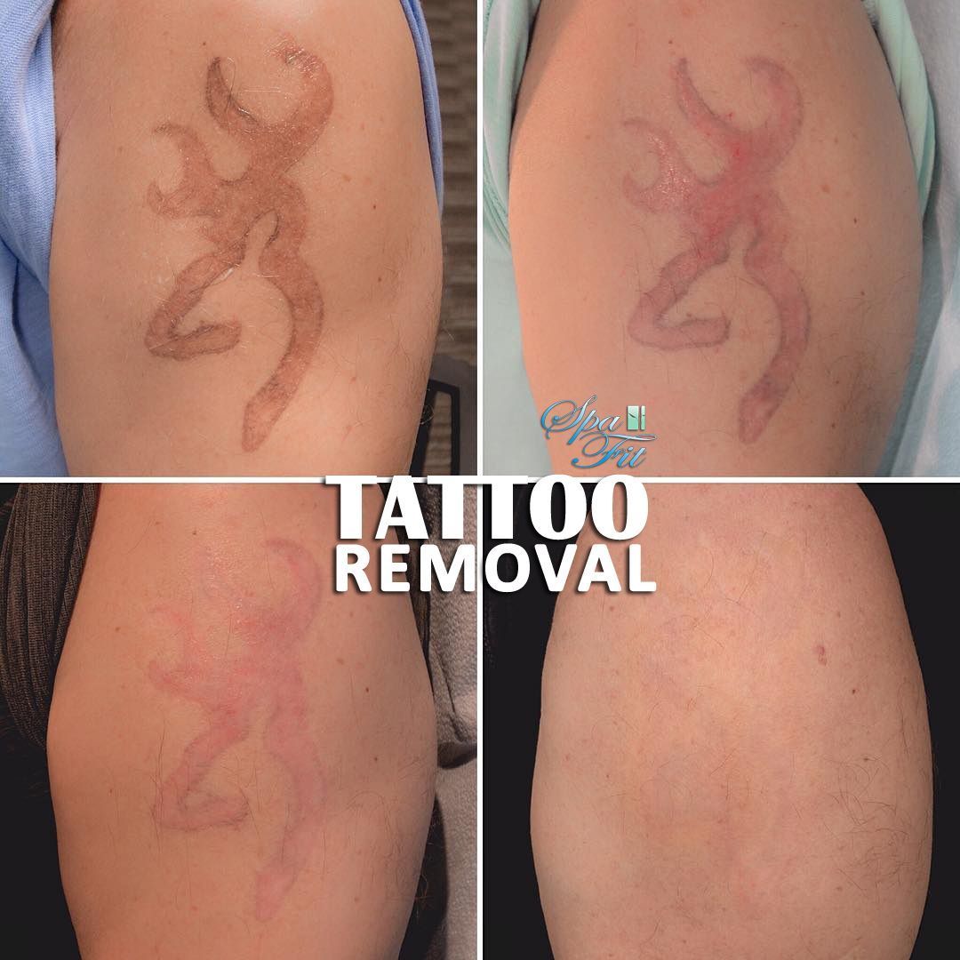 Our another happy client..!! Complete Tattoo Removal can be seen in ...