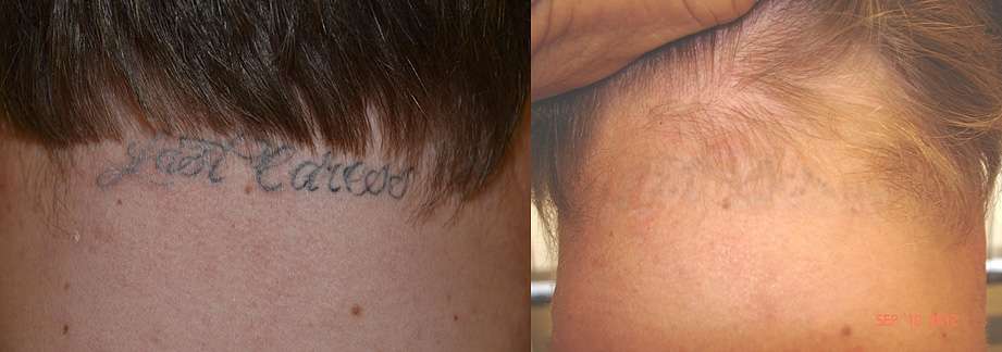 Painless Tattoo Removal Los Angeles, Beverly Hills CA