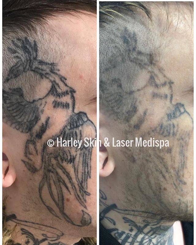 Part way through laser tattoo removal to the face. Using the latest ...