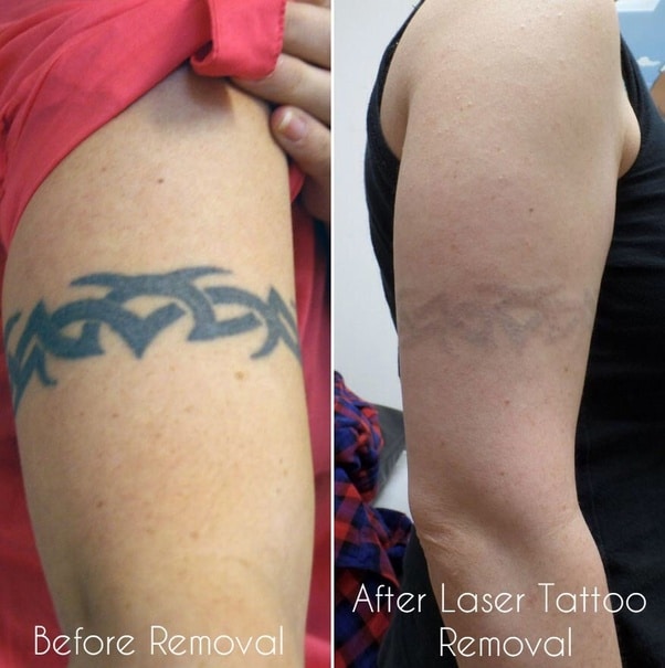 Permanent Tattoo Removal Cost In Chandigarh
