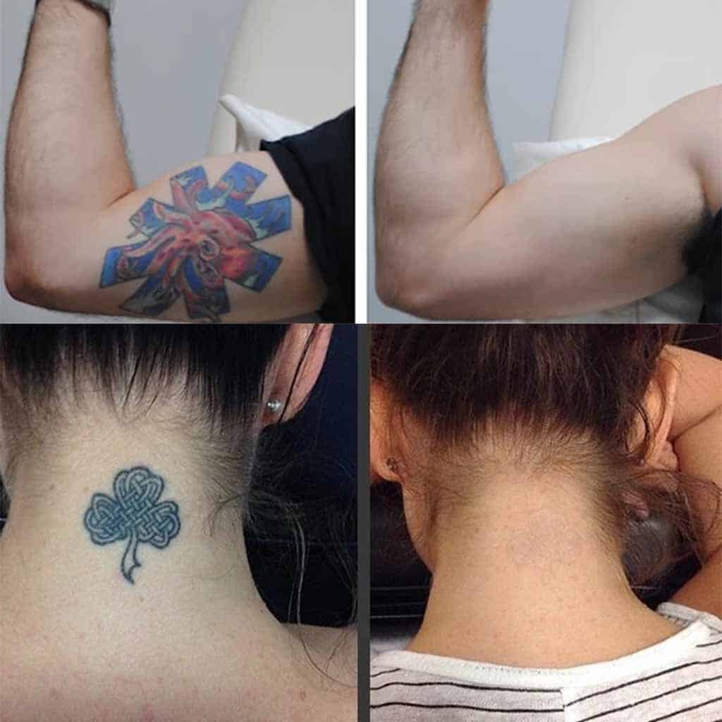 Permanent Tattoo Removal Cream â Dealz Ninjaa
