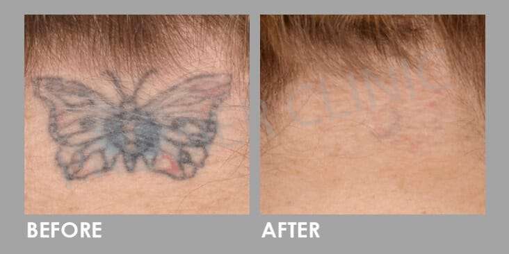 Permanent Tattoo Removal With Premier Pico Laser