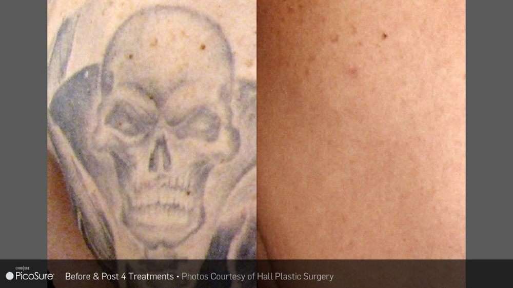 Phoenix Tattoo Removal and Skin Revitalization