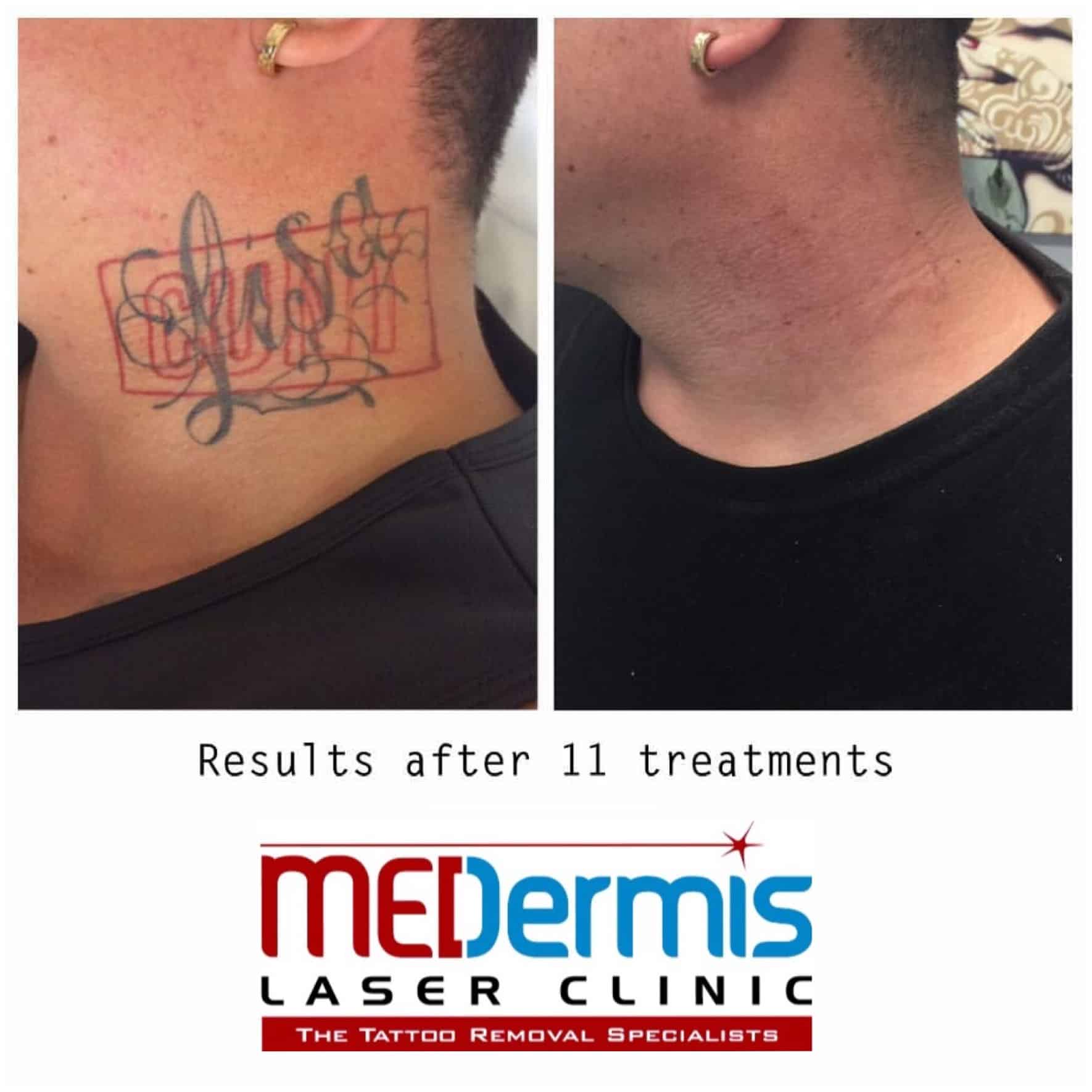 Photo Gallery: Laser Tattoo Removal Before &  After Results