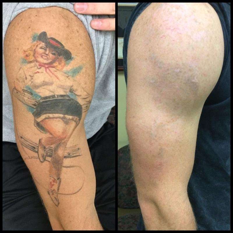 Photos for Absolute Laser Tattoo Removal