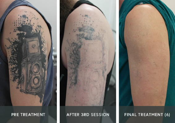 PicoLazer Tattoo Removal and Skin Revitalization