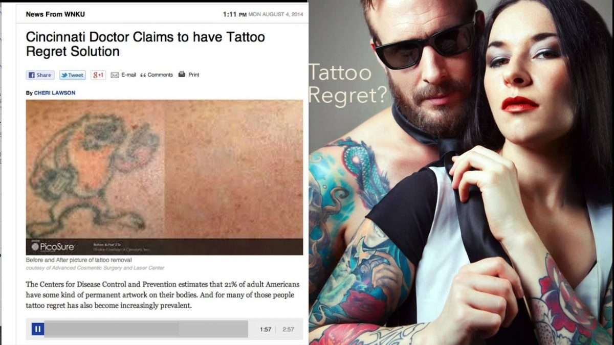 PicoSure Tattoo Laser Removal in Cincinnati Kentucky