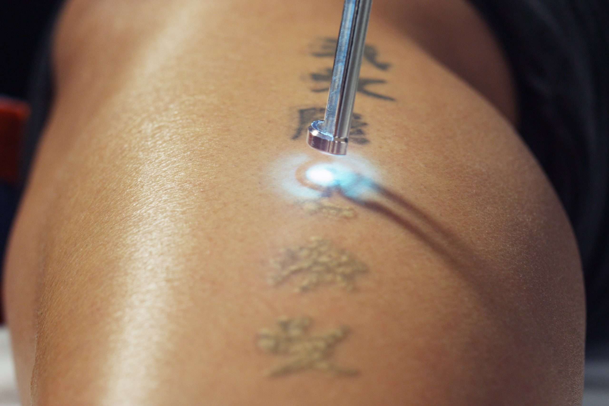 Pin by Cosmotree Clinic on Tattoo Removal in Delhi