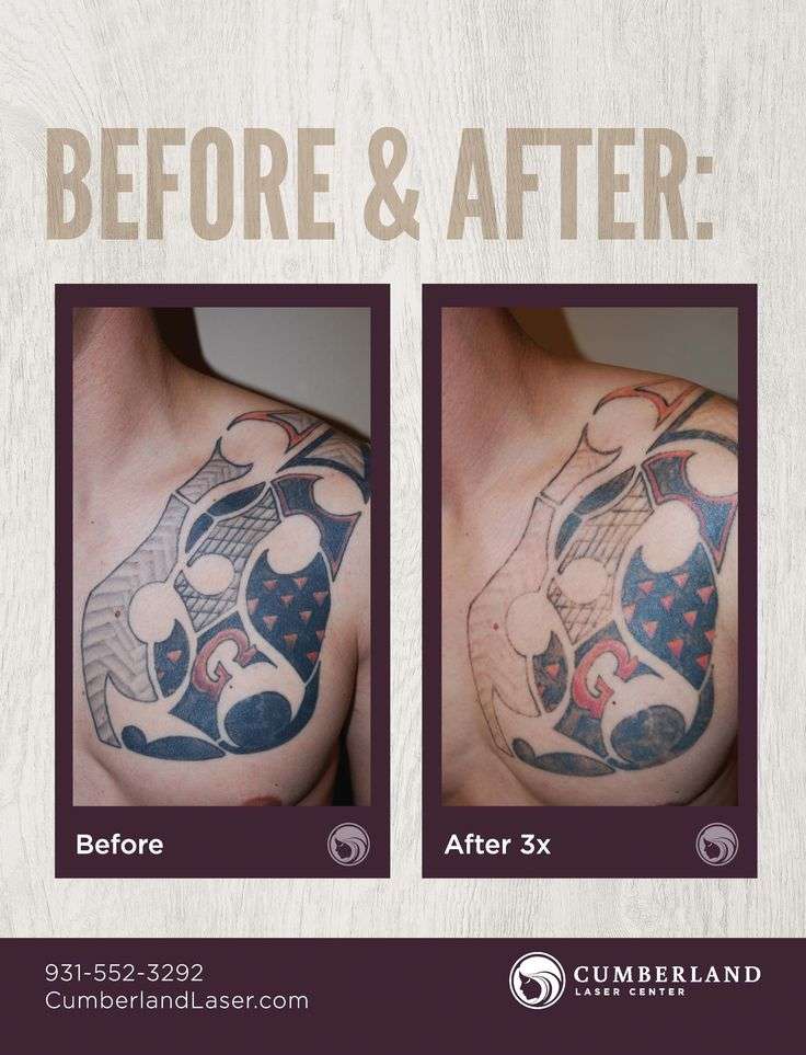Pin by Painless Tattoo Removal on Tattoo Removal