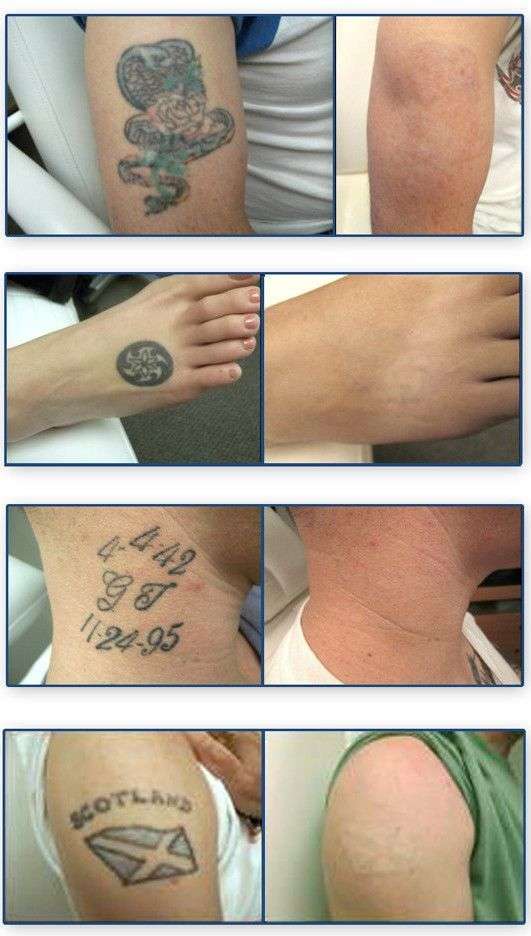 Pin by Tattoo Removal Treatment on Celebrity Tattoo ...