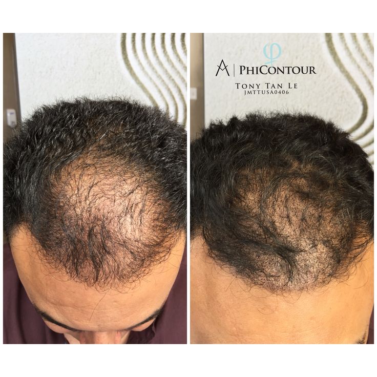Pin on Best Scalp Micropigmentation/ Scalp Tattoo/SMP in Maryland