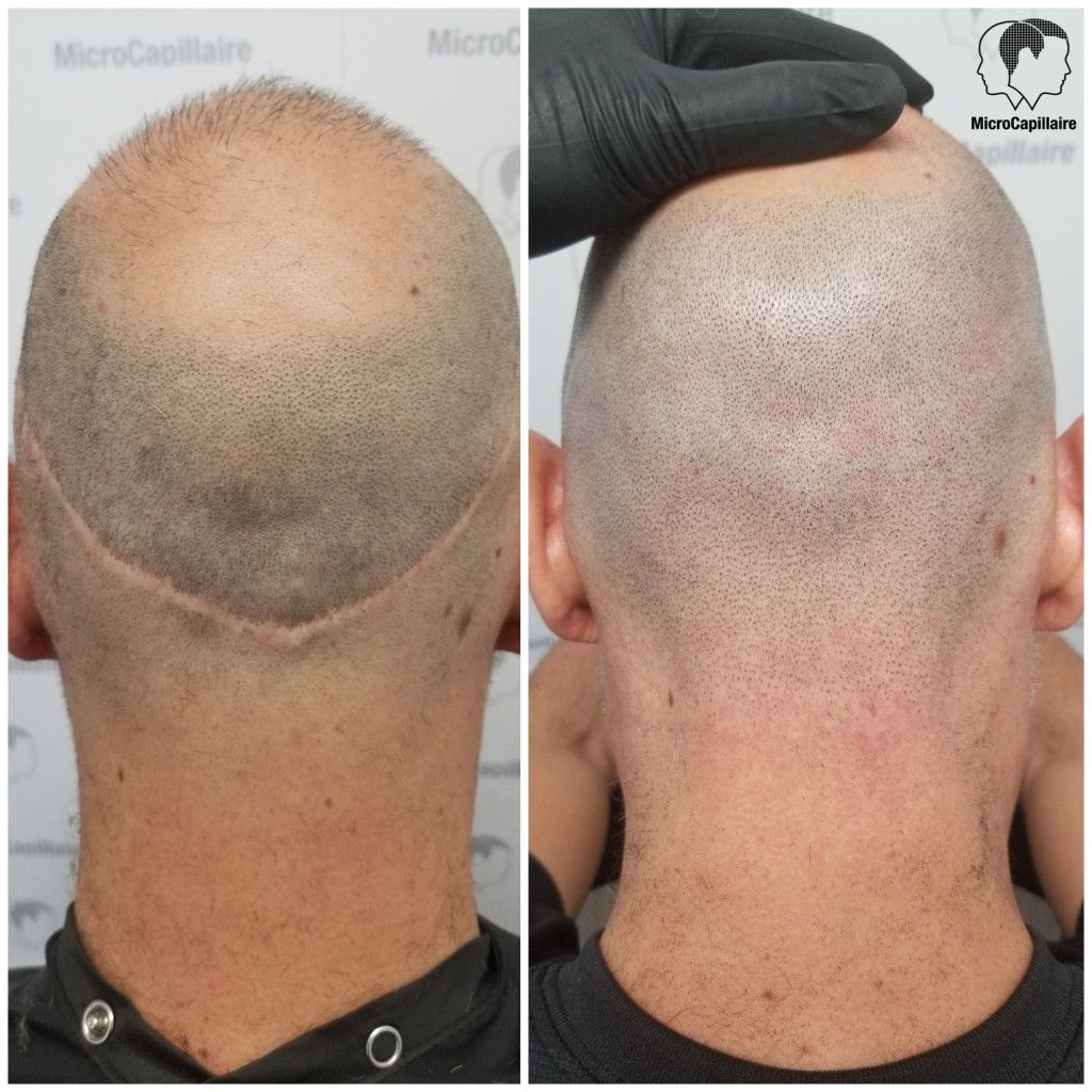 Pin on Hair loss treatment