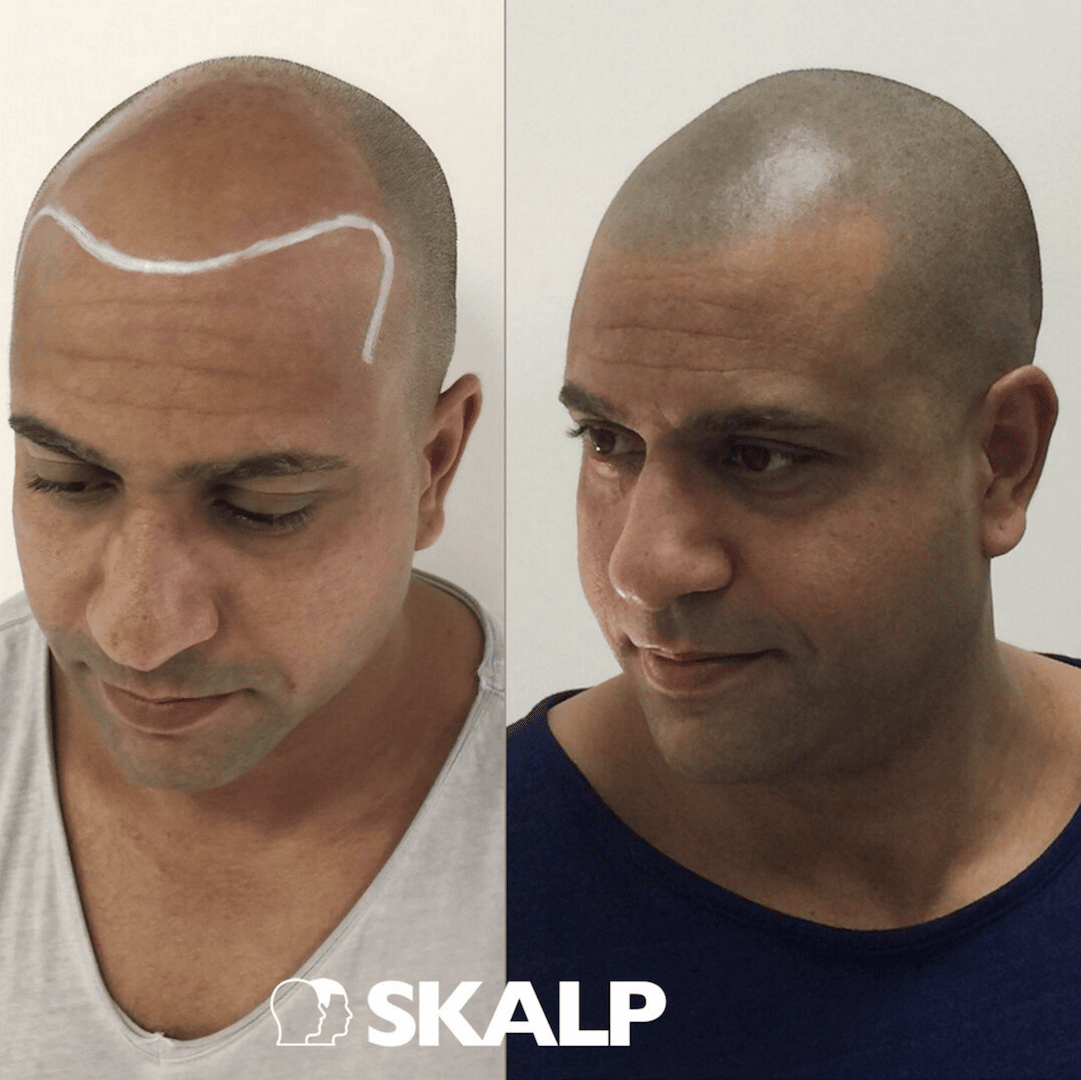 Pin on Scalp Micropigmentation Treatment Results
