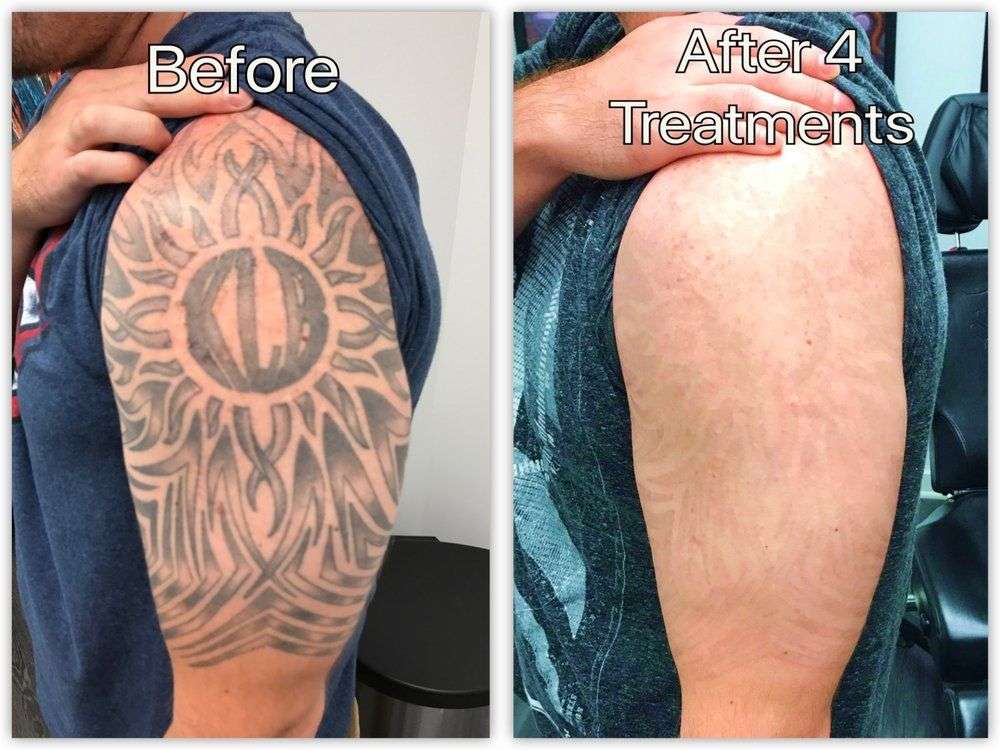 Pin on Tattoo Removal Before and After