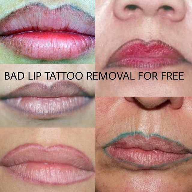 PMU by Vilma Karaliute on Twitter: " Bad lip tattoo removal for free ...