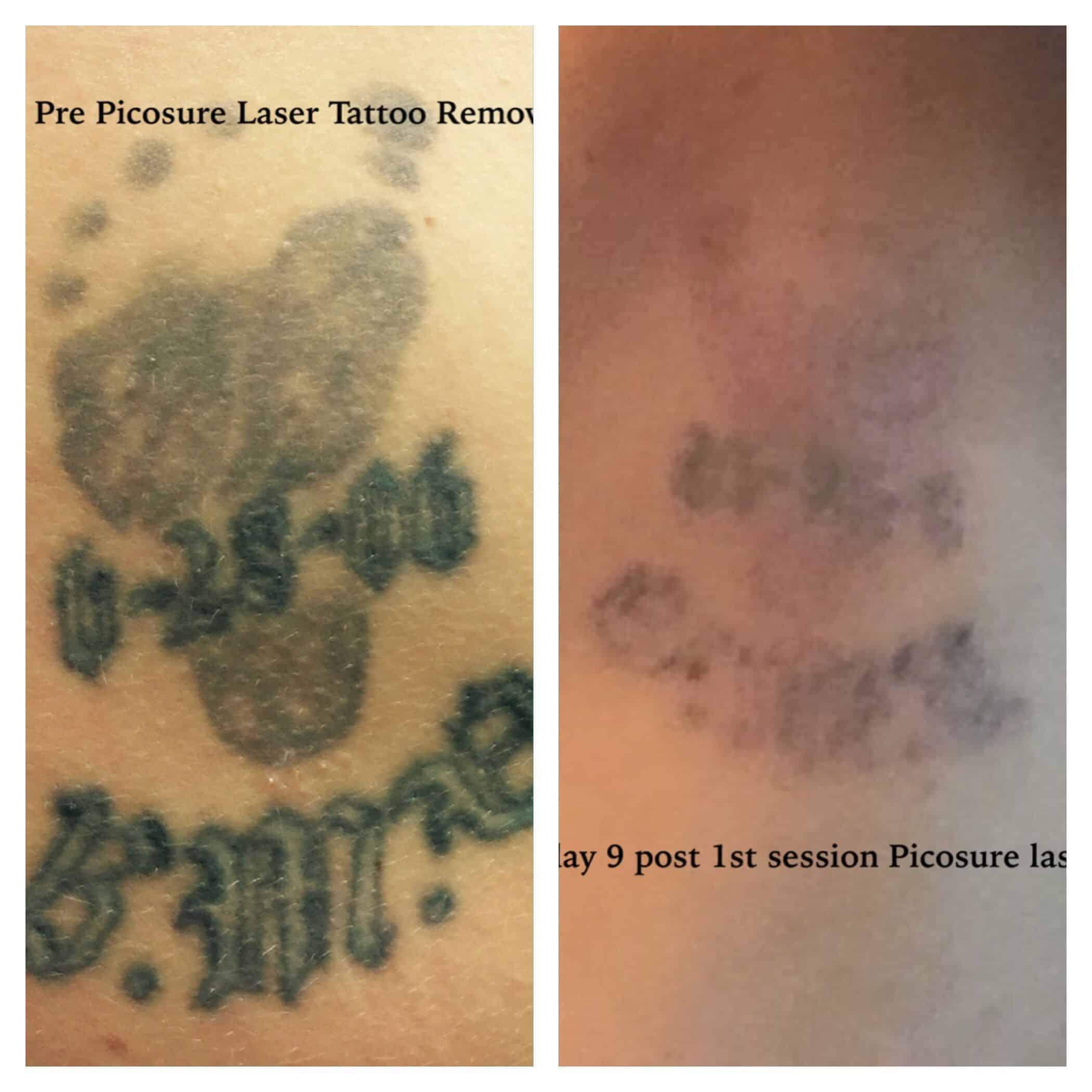Pre and day 9 post first session of Picosure laser tattoo removal ...