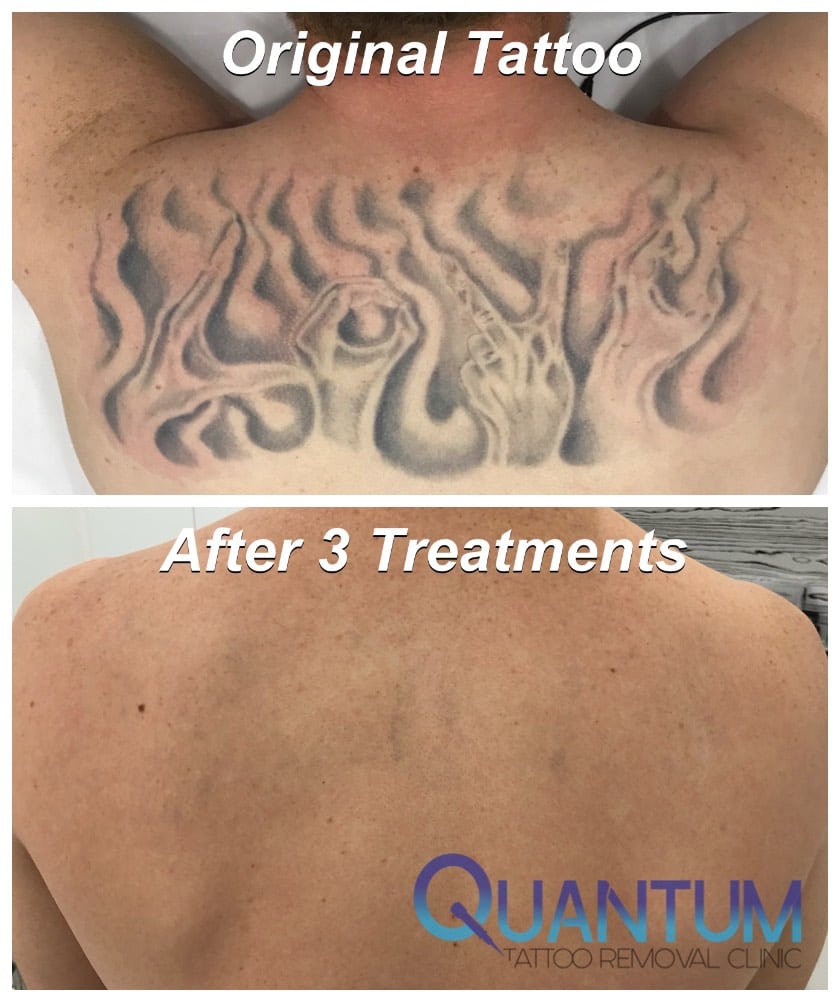 Professional Lightening Tattoo Removing in Brisbane, Australia