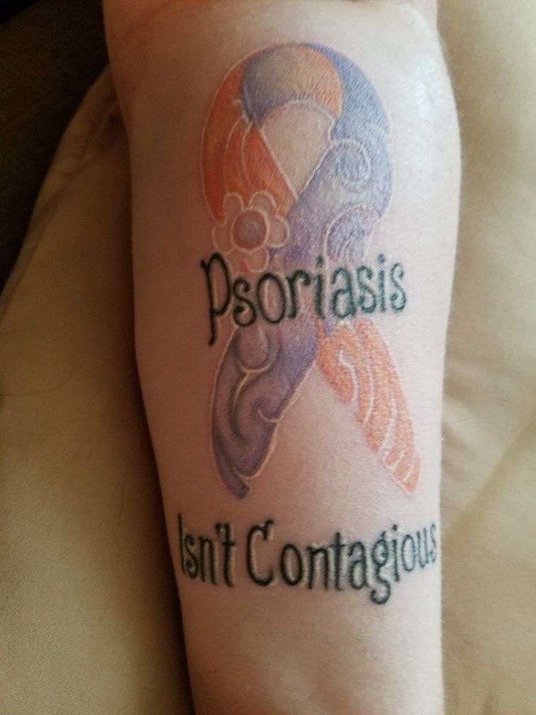 Psoriasis isn