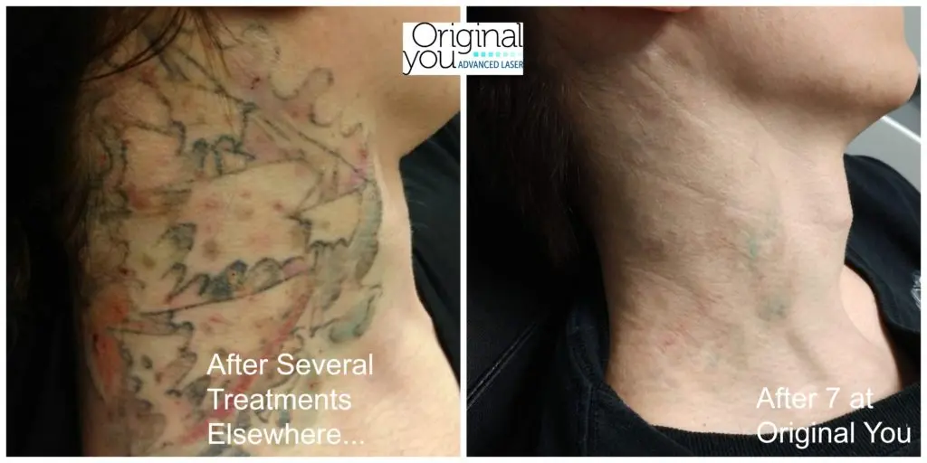 R20 Tattoo Removal Before And After