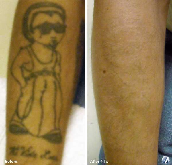 Rapid Laser Tattoo Removal Salinas