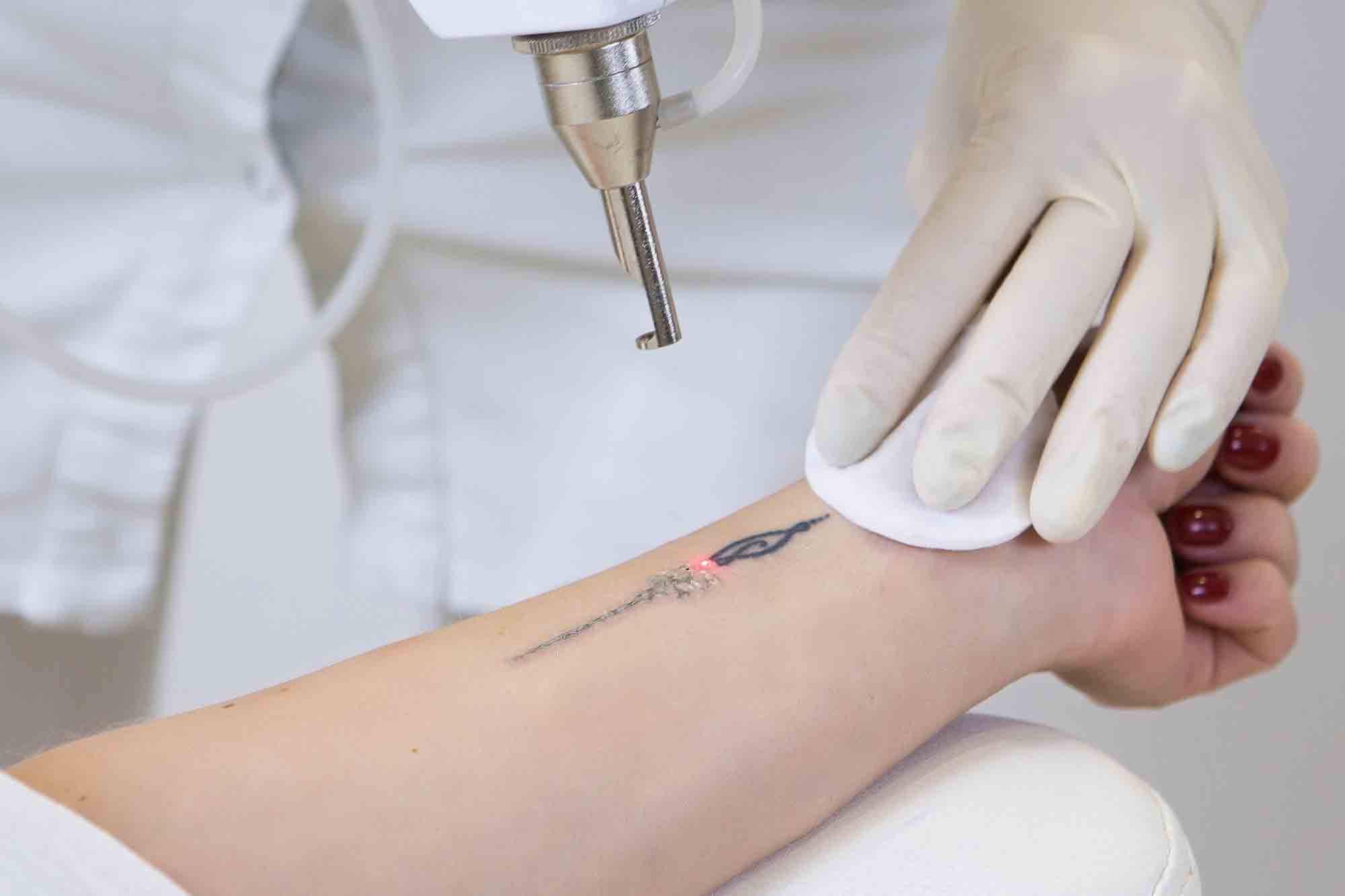 Reasons Why Laser Tattoo Removal Is The Best