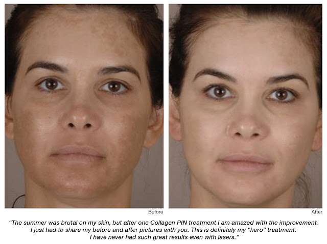 Redding Laser Tattoo Removal: Introducing Collagen P.I.N ...