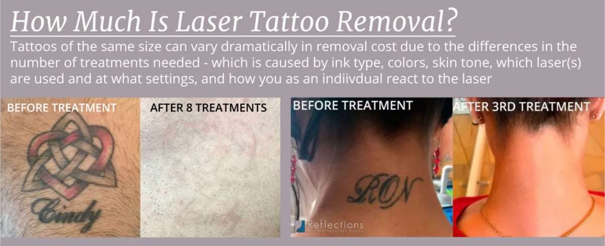 Reducing the Cost of Tattoo Removal: How to Maximize Your Laser Tattoo ...