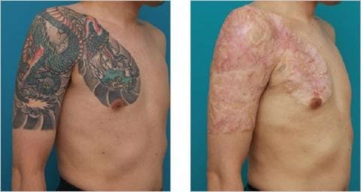 Remove Tattoo Cream Before And After